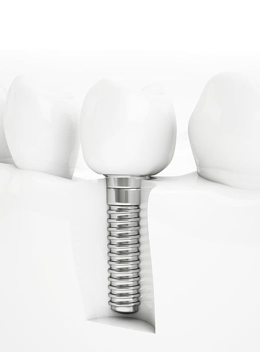 osteointegracion dental en implante