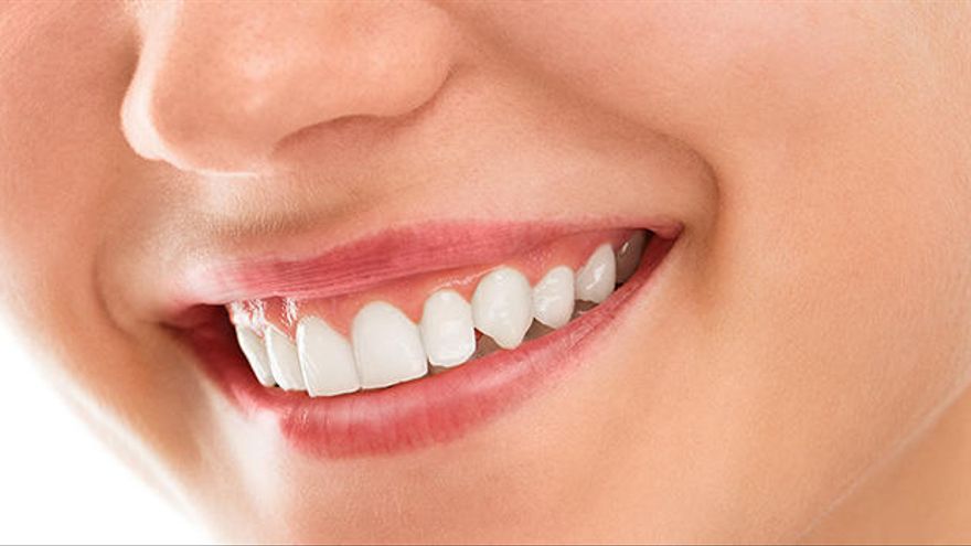 Implantes dentales Vf Clinic