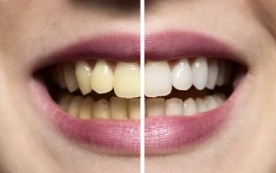Cuidados dentales después de las fiestas: vuelve a tu rutina