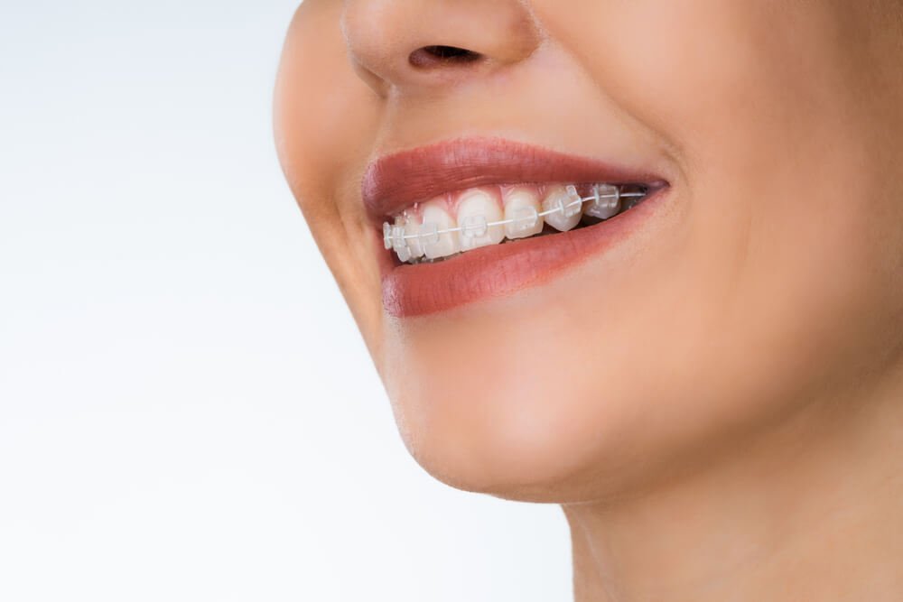 Brackets estéticos de zafiro en una sonrisa