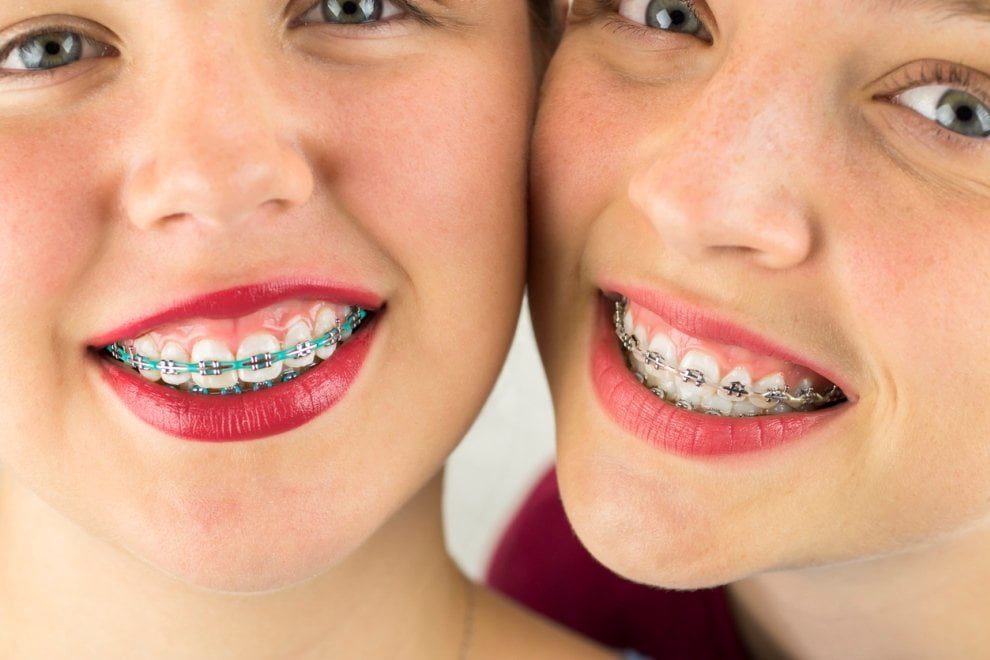 Brackets metálicos para tratamiento de ortodoncia